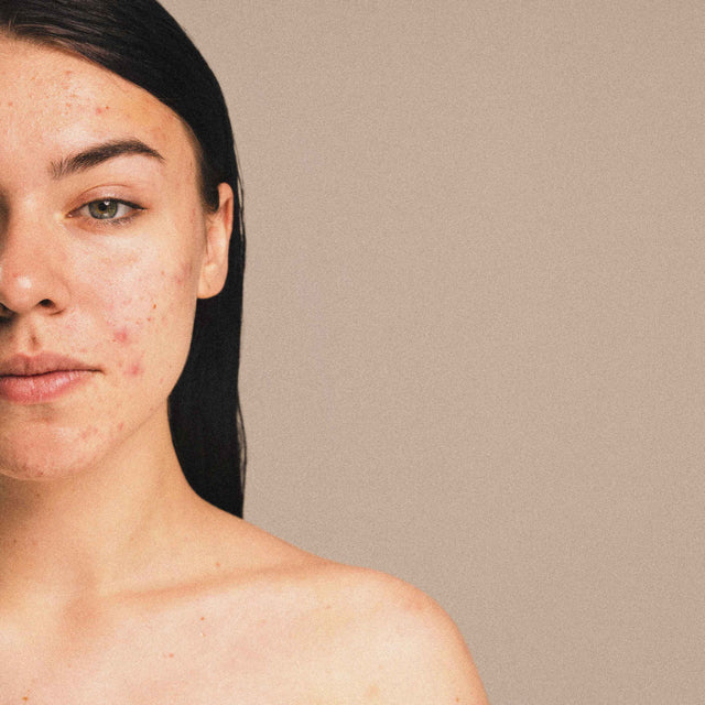 How to Get Rid of Blackheads: The Complete Guide
