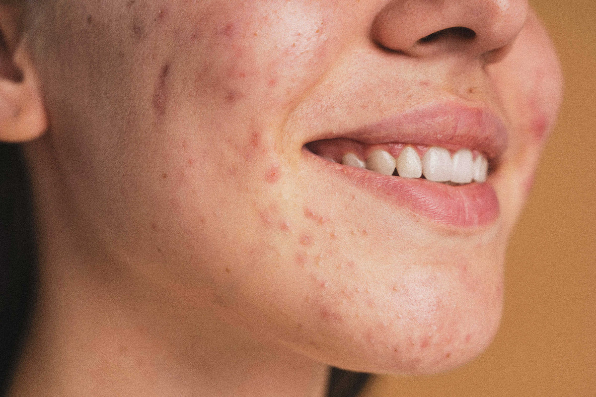 Types of Pimples: How to Identify and Treat Them